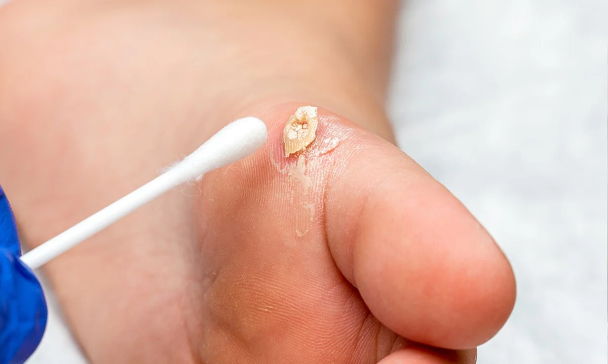 Ocet v teplé vodě: Jak se zbavit kopendy bez chemie za 10 minut - image 1